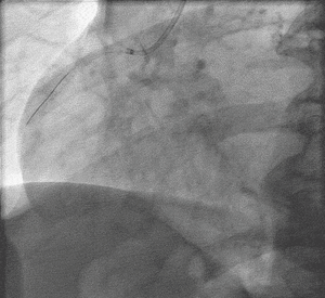 After-angioplasty